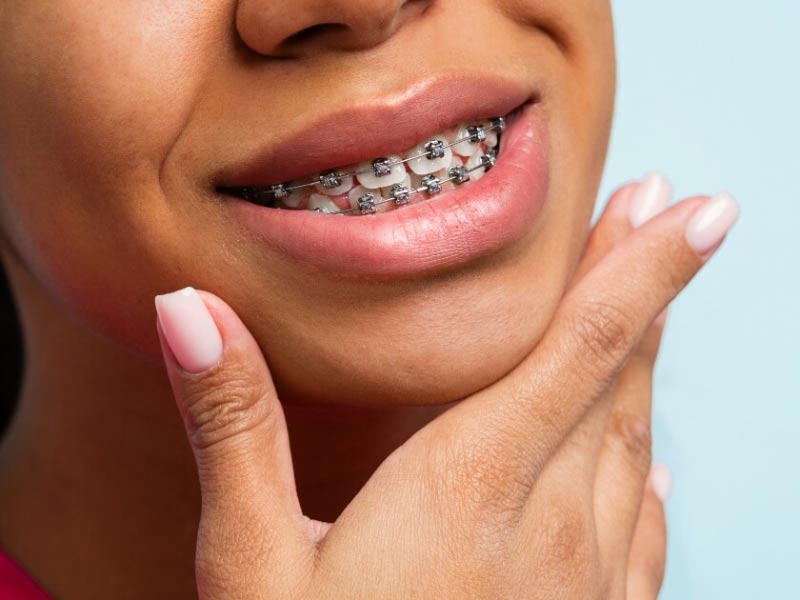 Featured image for “What Kind of Braces Are Right for Me?”